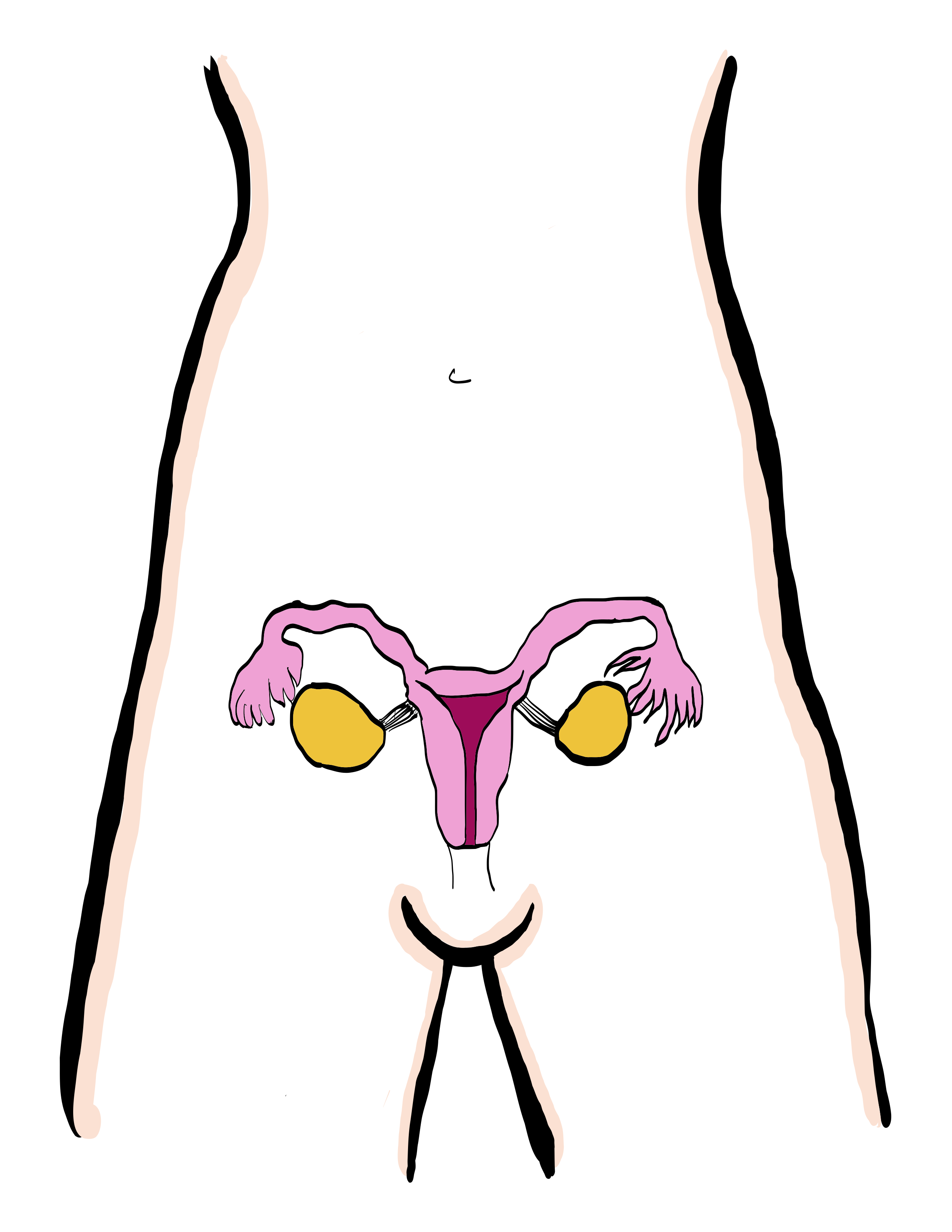 tratamiento-de-ovario-poliquistico